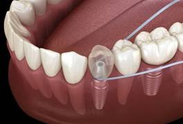 Dental Implant Floss