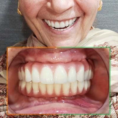 Patient - Smile after All-on-4 dental implants on both arches