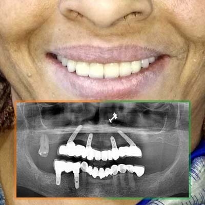Case 3: Smile and OPG after All-on-4 dental implants
