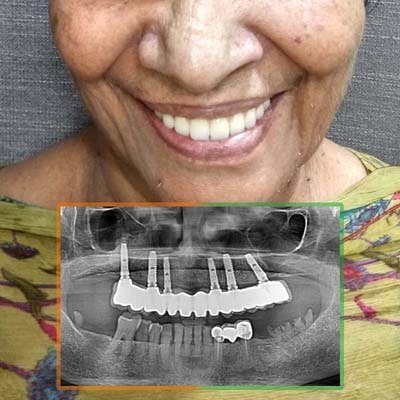 Case 4: Smile and OPG after All-on-6 dental implants