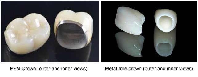 PFM Crown and Metal-free crown