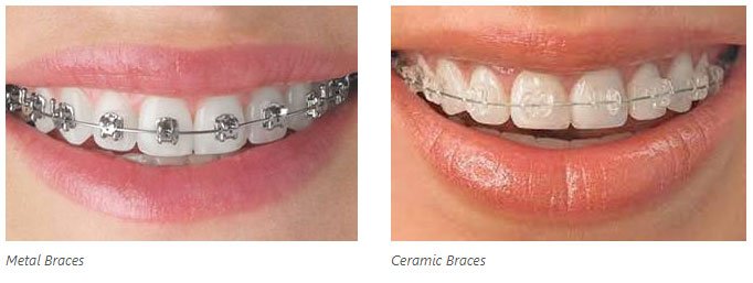 Metal Braces vs Ceramic Braces