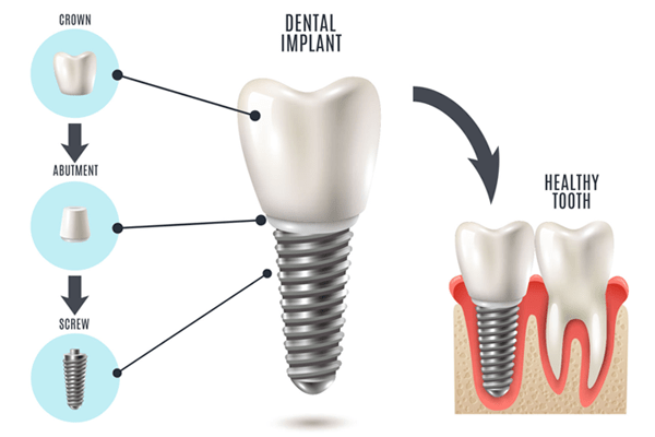 Dental Implant Parts