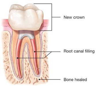 laser-assisted root canal treatment in India