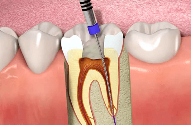 root canal treatment cost in India