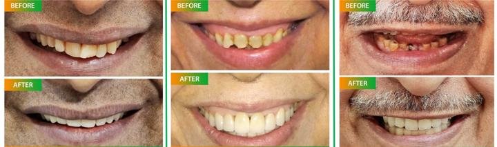 Smile Designing, Cosmetic Dentistry