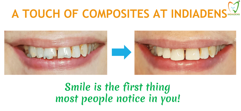 dental composites indiadens dental clinic