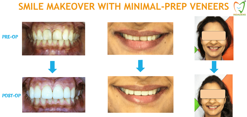 smile makeover with prep veneers