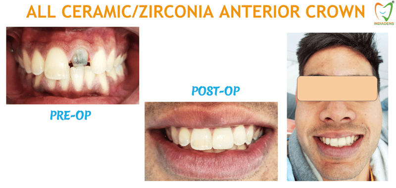 zirconia anterior crown
