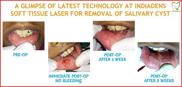 dental laser gums treatment at indiadens dental clinic south delhi