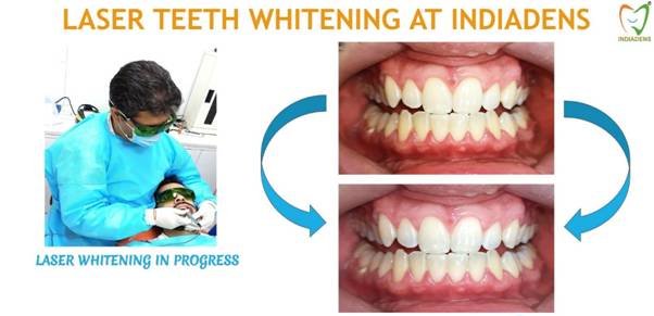 laser teeth whitening by dr ujjwal gulati at indiadens dental clinic delhi