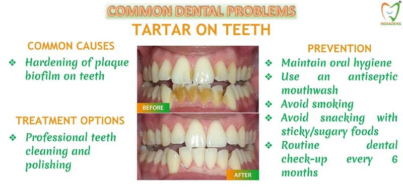 tartar on teeth - causes, treatment, prevention