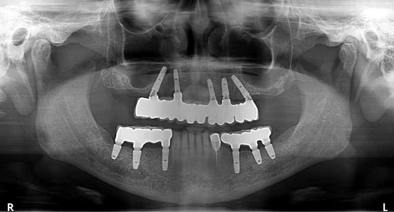OPG dental implants on upper lower jaw