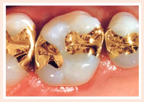 Gold tooth fillings