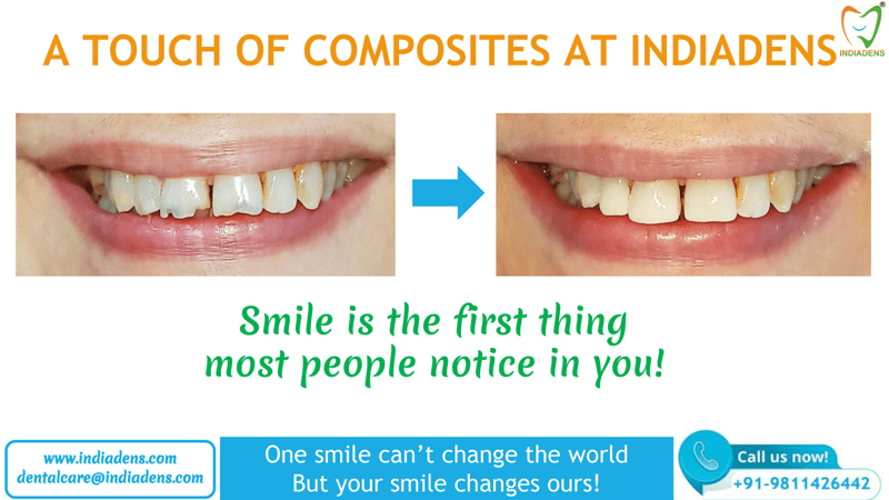tooth Composite fillings