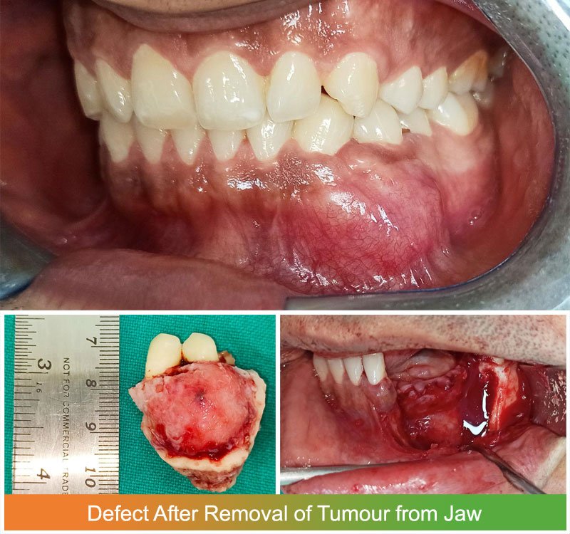 Defect after removal of Ameloblastoma tumour from jaw