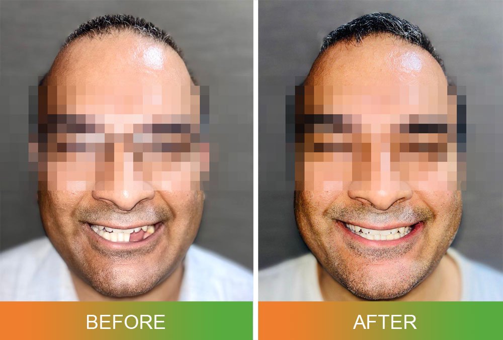 patient-specific implants before and after photo