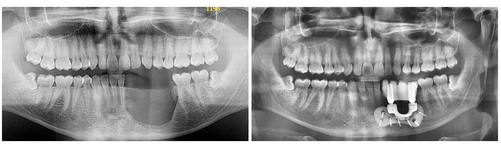 patient-specific implants scan