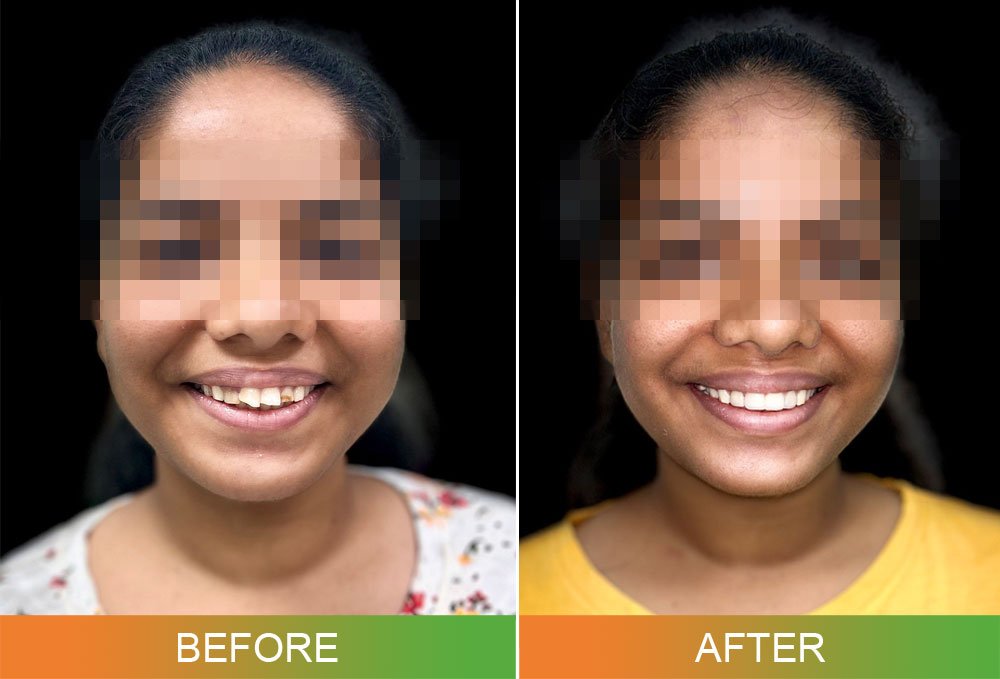 smile design before and after photos front