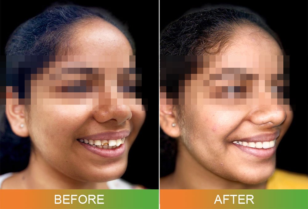 smile design before and after photos side