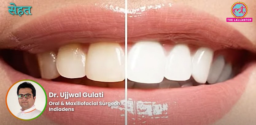 Teeth Whitening and Bleaching - Dr. Ujjwal-Gulati - The Lallantop Sehat Episode 964