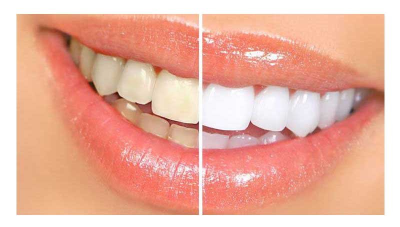 Yellow Teeth Treatment