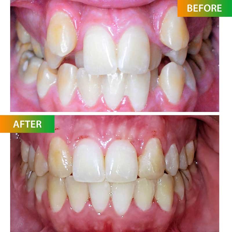 Misaligned Teeth Treatment
