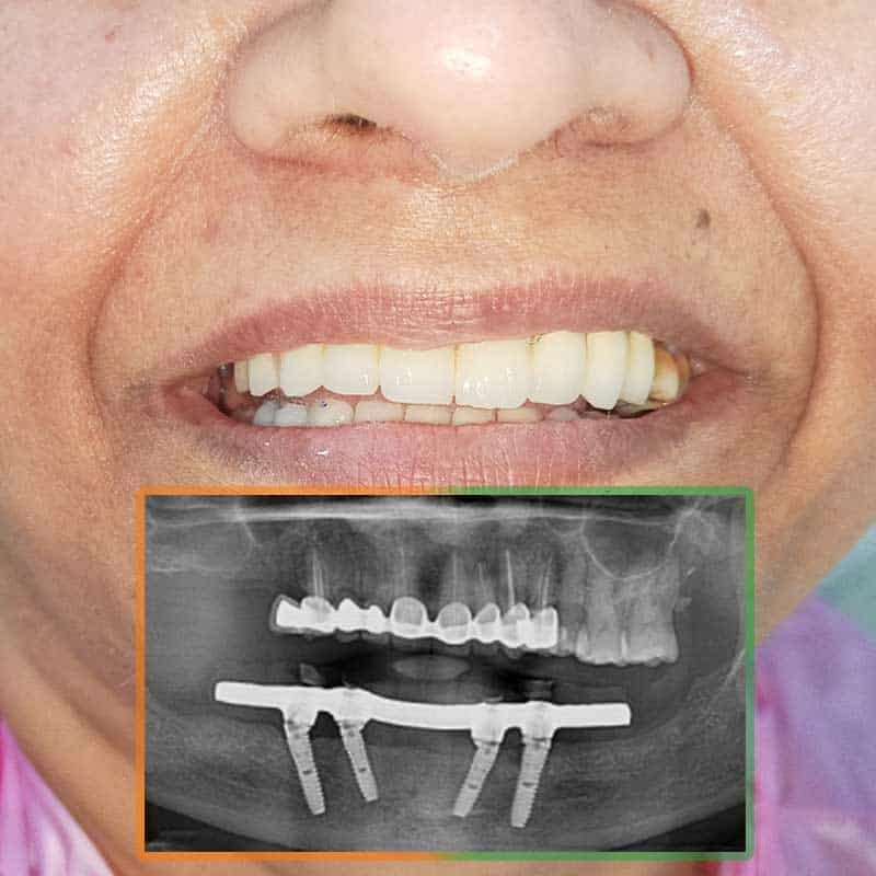 Dental Implant all-on-4 procedure of Satwant Kaur