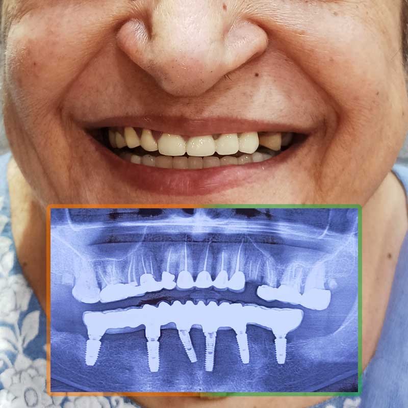 Dental Implant all-on-6 procedure of Madhu Bhatia