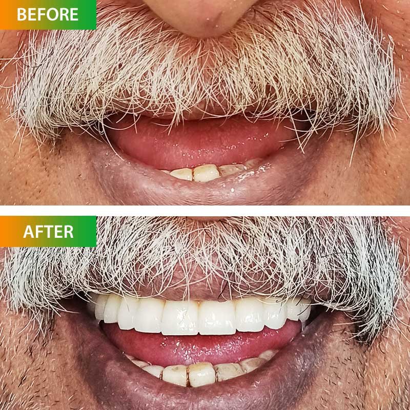 Dental Implant all-on-6 procedure of Sunil Malhotra