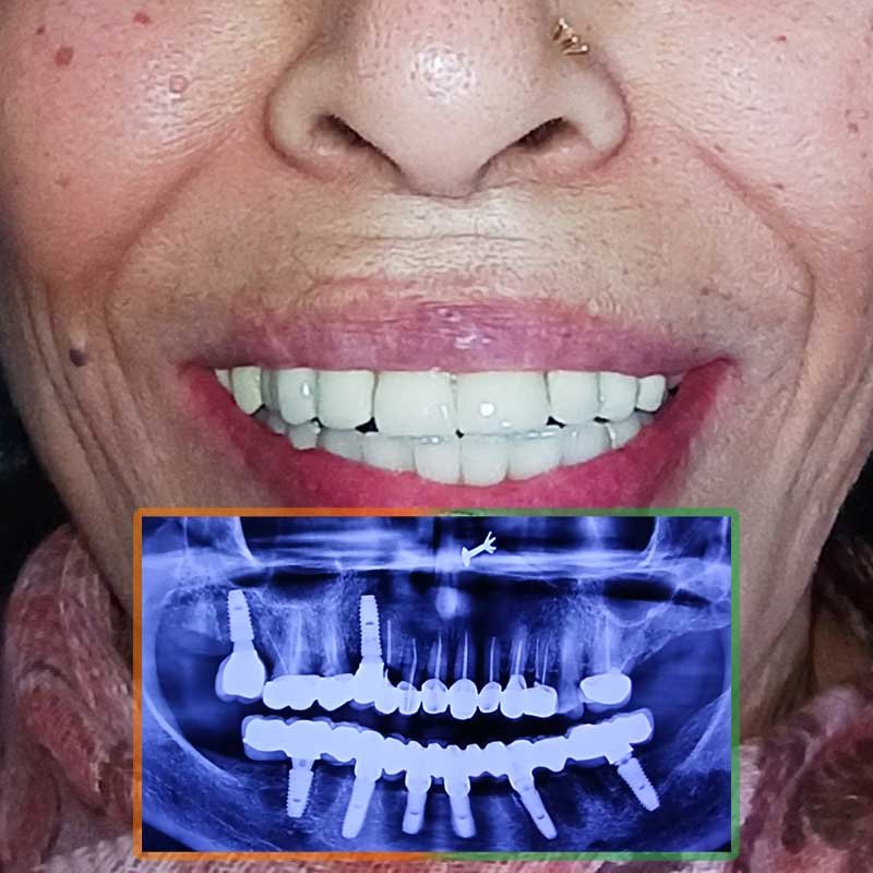 Dental Implant all-on-6 procedure of Kiram Sharma