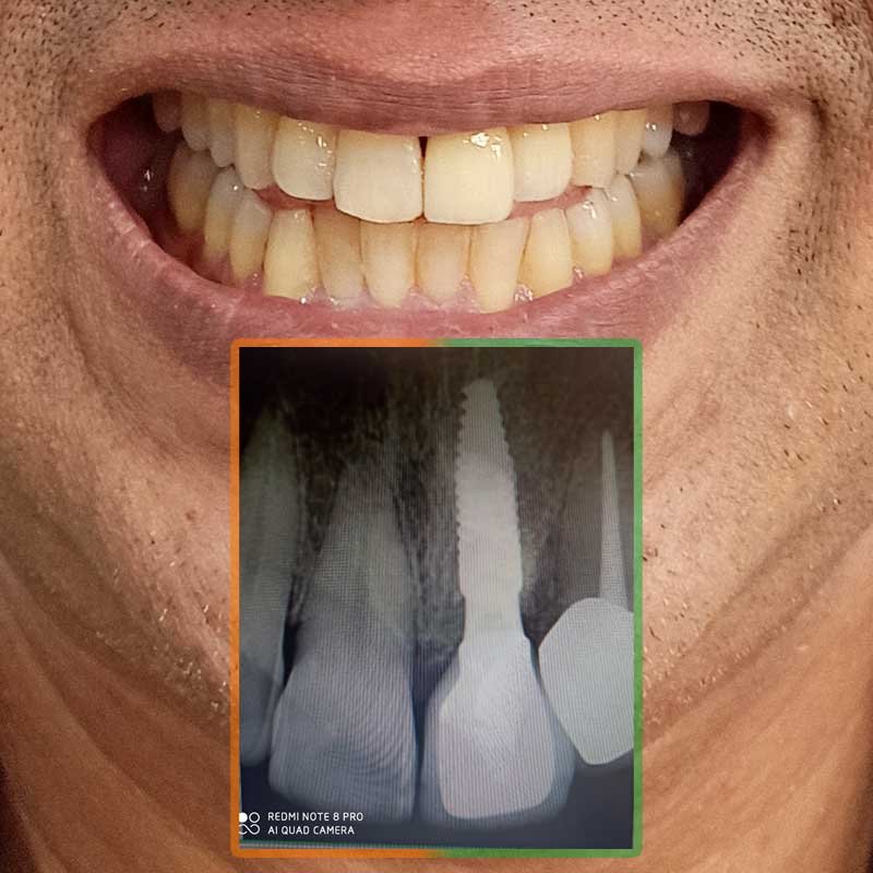 Single Anterior Tooth Implant of Sanjay Agarwal