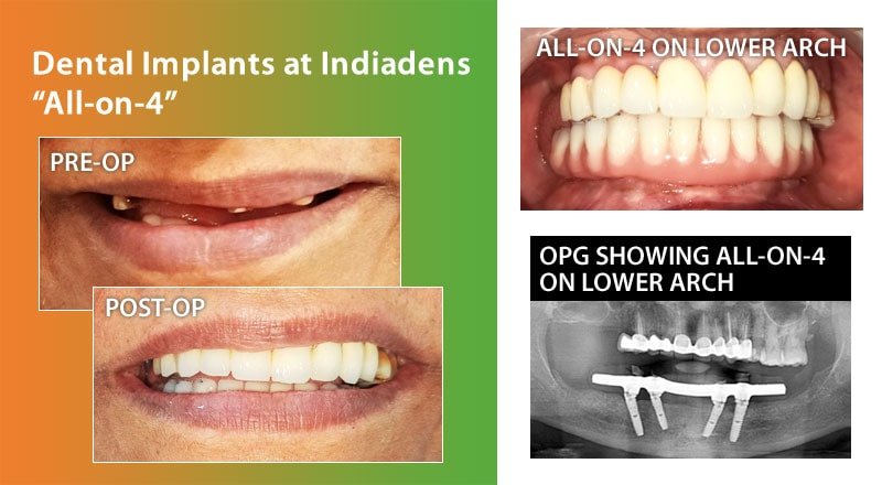 Dental implants all on 4 on lower arch at Indiadens, Delhi