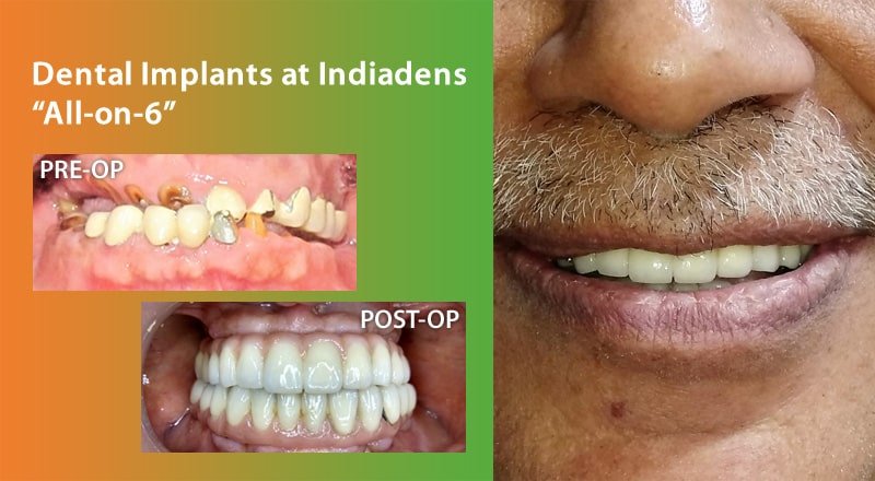 Full mouth dental implants all on 6 rehabilitation at Indiadens, Delhi