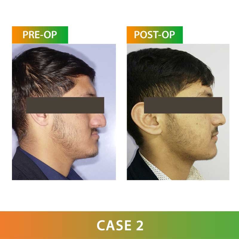 Major Orthognathic Surgery by Dr Ujjwal Gulati