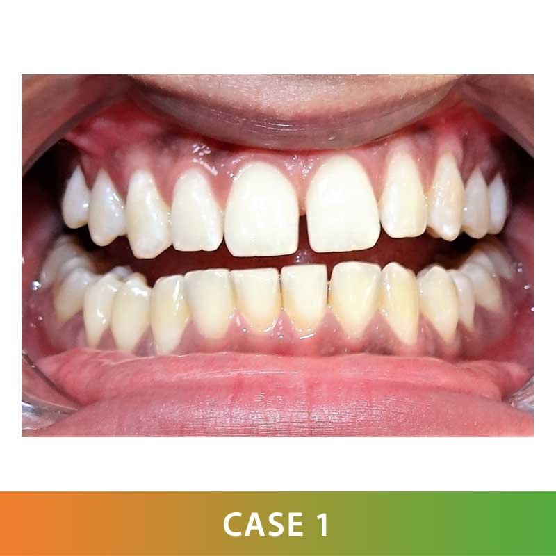 Laser Dentistry Teeth Whitening