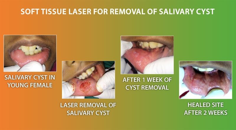 Dental Advacned Laser Technology